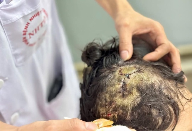 Liên tục có người bị chó nhà cắn thương tích, bác sĩ cảnh báo mối đe dọa khi mùa hè đến