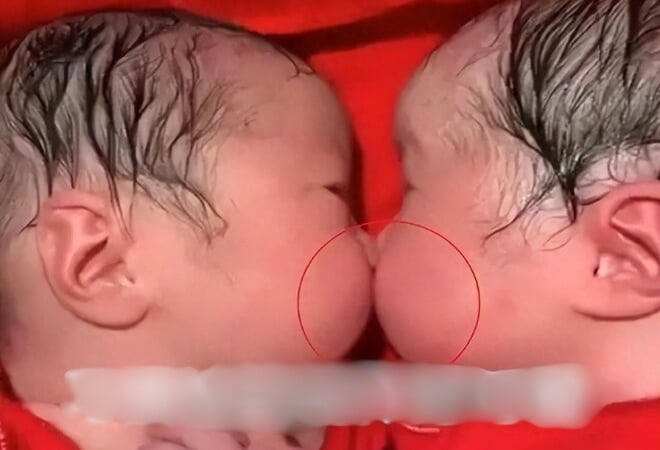 Cặp sinh đôi bám chặt lấy nhau khi mới chào đời, y tá không thể tách rời mà phải thốt lên: “Thật hiếm gặp”