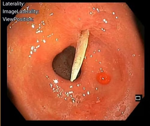 Hy hữu: Cụ bà 79 tuổi bị xương cá đâm thủng dạ dày