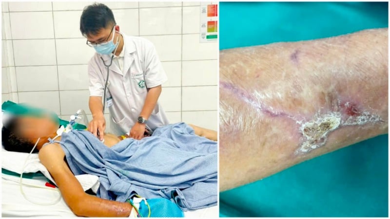 Co cứng toàn thân, suy hô hấp vì vết thương ngoài da 'tưởng nhẹ'