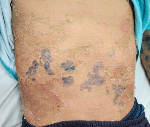 Toàn thân bị 'lột da' sau khi dùng lá tắm chữa bệnh sởi
