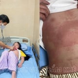 Nhiều trẻ phát ban, sẩn ngứa, bác sĩ cảnh báo bệnh mùa hè