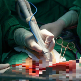 Bệnh viện đầu tiên tại miền Tây sử dụng hệ thống dao mổ siêu âm cắt gan cho bệnh nhân ung thư