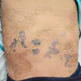 Toàn thân bị 'lột da' sau khi dùng lá tắm chữa bệnh sởi