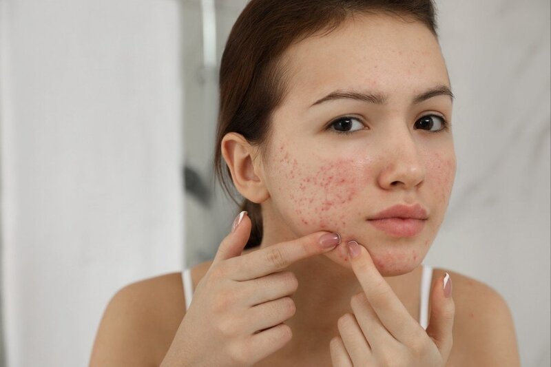 Mặt bất ngờ nổi mụn chi chít, đâu là nguyên nhân?