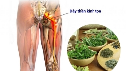 Điều trị đau thần kinh tọa bằng thuốc nam có hiệu quả không?