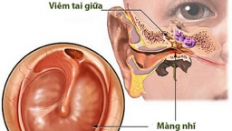 Thầy thuốc Y học cổ truyền chia sẻ bài thuốc trị viêm tai giữa