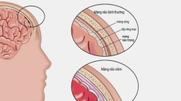 Sự nguy hiểm của bệnh viêm màng não mủ