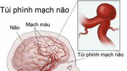 Bác sĩ Trường Dược Sài Gòn chia sẻ về túi phình mạch máu não