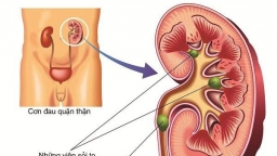 Có những loại sỏi tiết niệu nào bạn đã biết chưa?