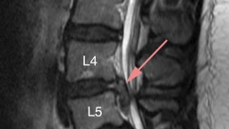 Thông tin về bệnh gai cột sống L4 L5