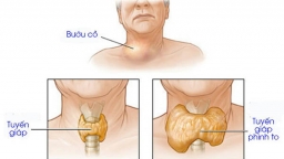 Nguyên nhân và cách phòng tránh bệnh basedow là gì?