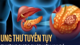 Những cảnh báo đáng lo ngại về ung thư tuyến tụy