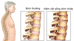 Những đối tượng nào có thể bị viêm cột sống dính khớp?