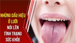 Bác sĩ Trường Dược Sài Gòn chia sẻ về 4 bệnh thường gặp ở lưỡi