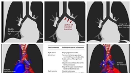 Lớn các buồng tim trên X-Quang