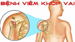 Nguyên nhân gây nên bệnh viêm quanh khớp vai là gì?