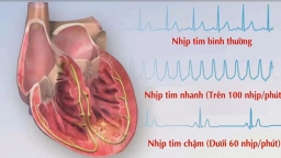 Bệnh nhịp tim chậm và lưu ý từ B.s Trường Dược Sài Gòn