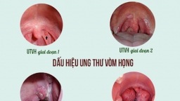 Cảnh báo dấu hiệu nguy hiểm của bệnh ung thư vòm họng