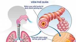 Những lưu ý về biến chứng của viêm phế quản cấp