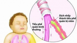 Những yếu tố điển hình khiến bệnh hen phế quản nặng lên