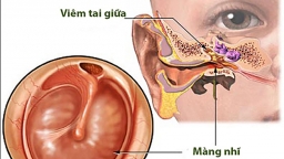 Tìm hiểu nguyên nhân viêm tai giữa và cách điều trị bệnh hiệu quả