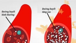 Dấu hiệu tăng đường huyết cần biết và cách xử lý kịp thời