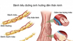 Tại sao bệnh đái tháo đường gây loét bàn chân?