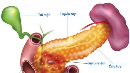 Bệnh nhân bị viêm tụy mạn tính thường có triệu chứng như thế nào?