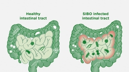 Nguyên nhân gây hội chứng loạn khuẩn ở ruột non bạn nên biết