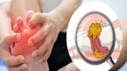 Các biện pháp giảm acid uric máu và kiểm soát bệnh gout