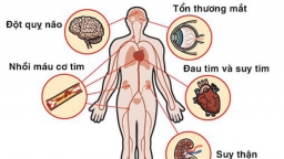 Bệnh tăng huyết áp nguyên phát gây những biến chứng nguy hiểm nào?