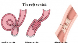 Tìm hiểu chứng tắc ruột sơ sinh và phương pháp điều trị bệnh