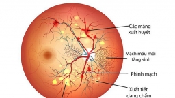 Những nguyên nhân nào thường gây nên bệnh lý võng mạc?