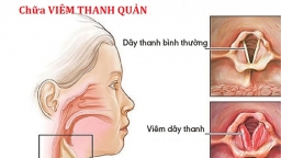 Bệnh nhân bị viêm thanh quản cần có những biện pháp điều trị nào?