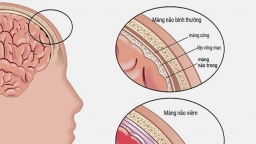 Cùng tìm hiểu bệnh lý viêm màng não mủ và phương pháp điều trị