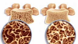 Tìm hiểu bệnh viêm tủy xương và các biện pháp điều trị