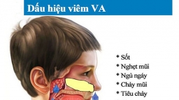 Tìm hiểu bệnh viêm VA và phương pháp điều trị bệnh