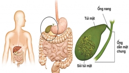 Bệnh nhân viêm túi mật thường gặp những biến chứng nguy hiểm nào?