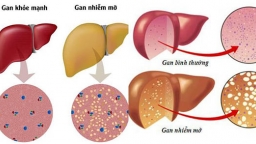 Tìm hiểu nguyên nhân và cách phòng tránh bệnh gan nhiễm mỡ