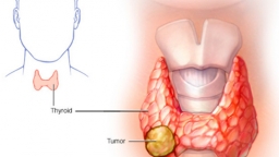 Vì sao bệnh ung thư tuyến giáp ngày càng gia tăng?