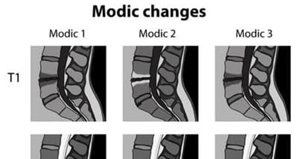 Tác động của thoái hóa Modic 1 đến sức khỏe và chất lượng cuộc sống?
