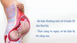 Mang thai bị trĩ, bà bầu khổ sở mới tìm được cách điều trị