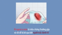 Triệu chứng điển hình của bệnh trĩ, đừng nhầm lẫn với bệnh khác