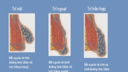 Bệnh Trĩ ngoại: Nguyên nhân, dấu hiệu và cách điều trị