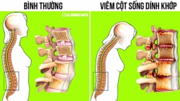 Những dấu hiệu sớm cảnh báo bệnh viêm cột sống dính khớp