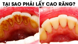 3 lý do vì sao bạn phải lấy cao răng thường xuyên