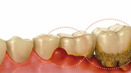 Chảy máu chân răng là bệnh gì? 10 nguyên nhân gây chảy máu chân răng