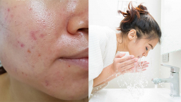 7 sai lầm tai hại khi chăm sóc da khiến lỗ chân lông to, gây mụn xấu xí