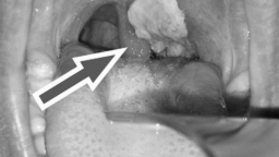 Bệnh bạch hầu có nguy hiểm không? Bệnh bạch hầu lây lan thế nào?